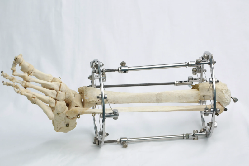 Операции при ДЦП в институте Илизарова